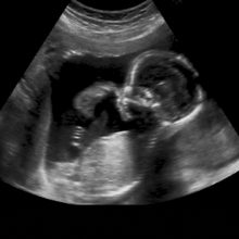 Hamilelikte Ultrason Neden Yapılır?
